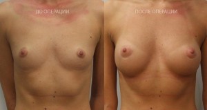 Маммопластика груди
